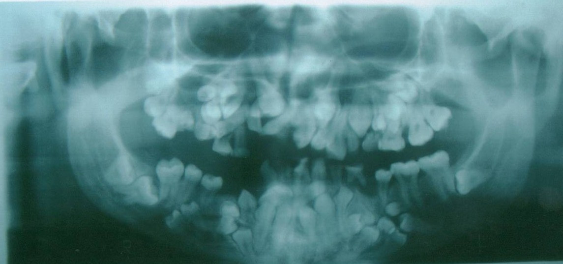 Hyperdontia, meaning excessive teeth.