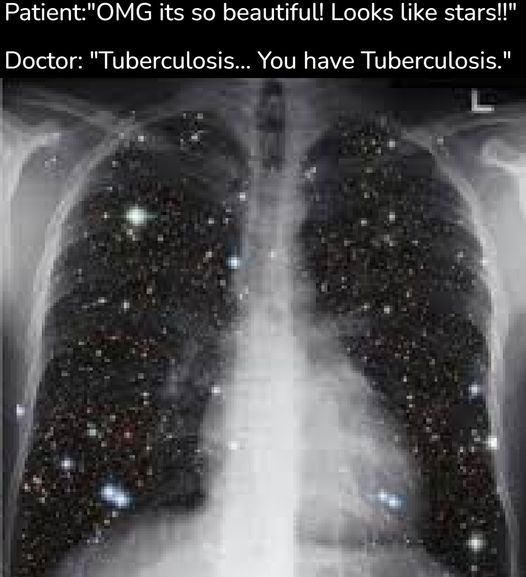 You have tuberculosis